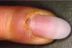 Périonyxie /Infection autour de l'ongle